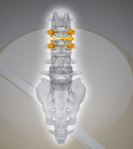 Sistema de osteosíntesis lumbar - NEX D2 - Next Orthosurgical - vía posterior / para adulto