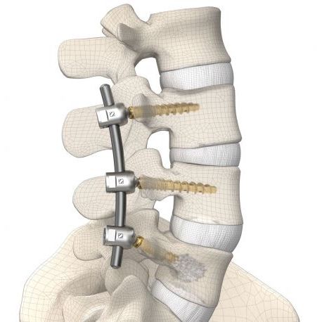 Sistema de osteosíntesis toracolumbar - DIPLOMAT®  - Signus Medical - vía posterior / para adulto