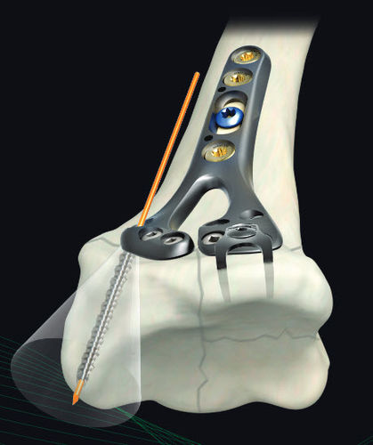 Placa de compresión para radio - GEMINUS ® - Skeletal Dynamics - porción distal / metálica