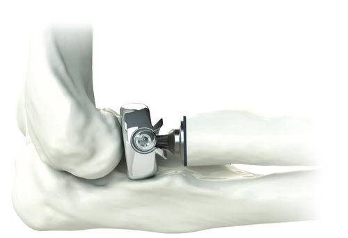 Prótesis de cabeza de radio - ALIGN ® - Skeletal Dynamics