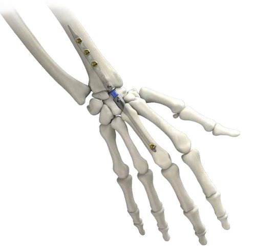 Clavo intramedular para muñeca - IMPLATE ® - Skeletal Dynamics