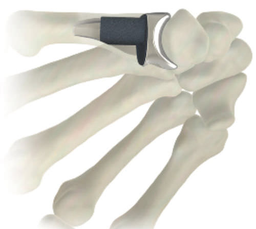 Implante metacarpofalángico - STABLYX ® - Skeletal Dynamics