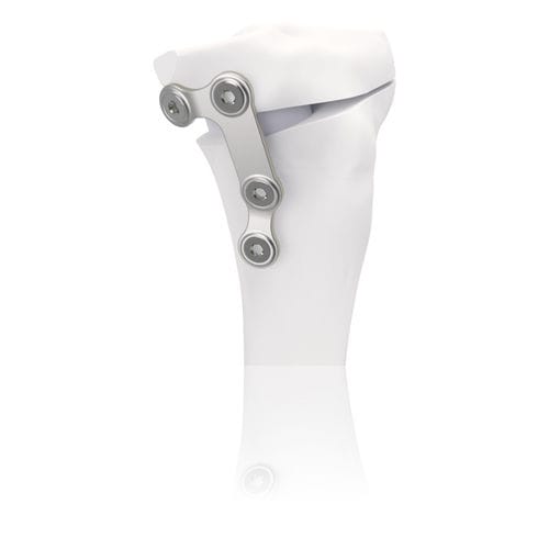 Placa de osteotomía para tibia - TBFIX™ - Groupe Lépine - de acero inoxidable