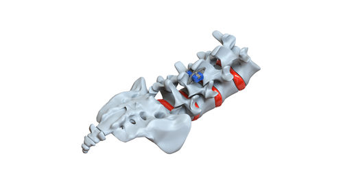 Implante vertebral interespinoso lumbar - STRATOS - Osimplant