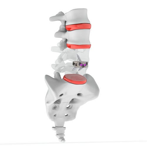 Caja intersomática lumbar - ANTENOR STAND ALONE ALIF CAGE - Osimplant - vía anterior / de titanio
