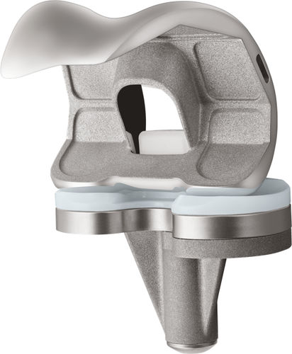 Prótesis de rodilla tricompartimental - U2™  - US Orthopedics - de platillo fijo
