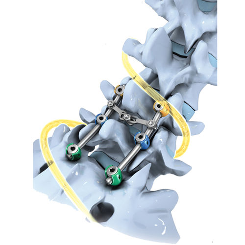 Sistema de osteosíntesis lumbosacro - SLICK'S® - Biotechni - vía posterior / para adulto