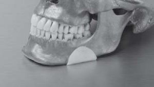 Implante mandibular - OP7550 - Matrix Surgical USA - anatómico / de polietileno