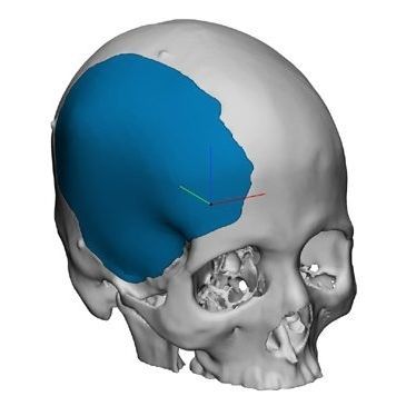 Implante craneal a medida - OP89020 - Matrix Surgical USA