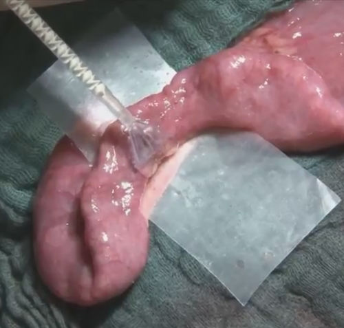 Cola quirúrgica para cirugía vascular - VIVO - Adhesys Medical