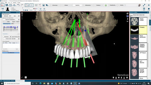 Software de implantología dental - NemoScan - Nemotec - de visualización 3D / de análisis / de gestión de datos de pacientes