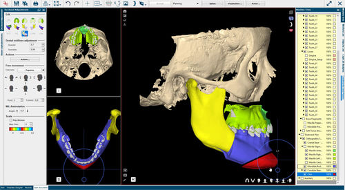 software de planificación preoperatoria - Nemotec