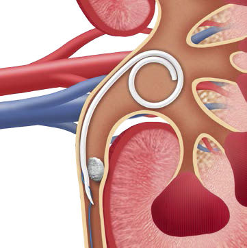 Stent ureteral - JFil®  - ROCAMED - de nitinol