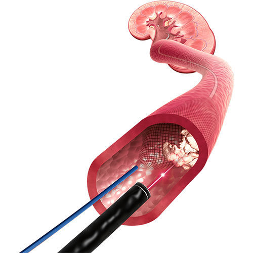 Stent arteria renal - X-Filter™ - ROCAMED - de nitinol