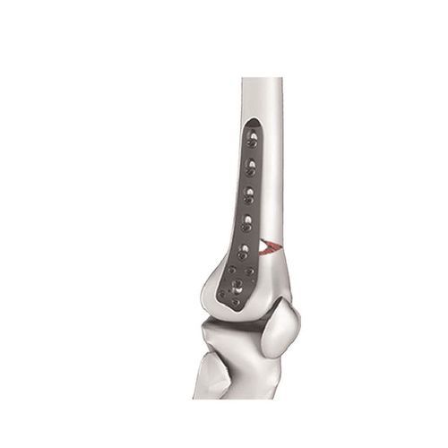 Placa de osteotomía para fémur - 122532104 - Canwell Medical - porción distal / lateral / bloqueada