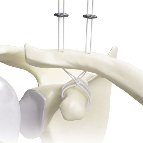Botón de sutura para la reconstrucción del ligamento acromioclavicular - Diamond - Canwell Medical