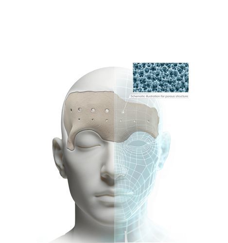 Implante impreso en 3D - Kontour Medical Technology - facial / anatómico / de PEEK