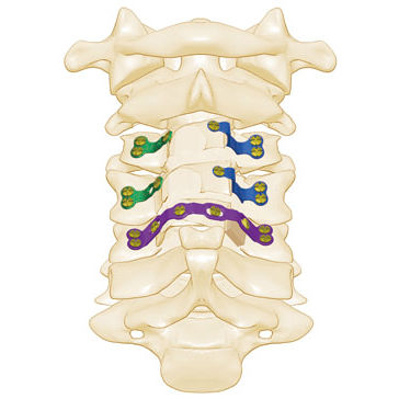Placa para laminoplastia para vértebra cervical - Rita - Shanghai Sanyou Medical - para vértebra