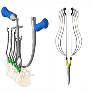 Sistema de posicionamiento de tornillos pediculares mínimamente invasivo - Zina™ - Shanghai Sanyou Medical