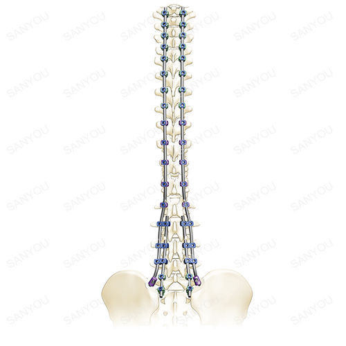 Sistema de osteosíntesis toraco-lumbo-sacro - Adena - Shanghai Sanyou Medical - vía posterior / para adulto