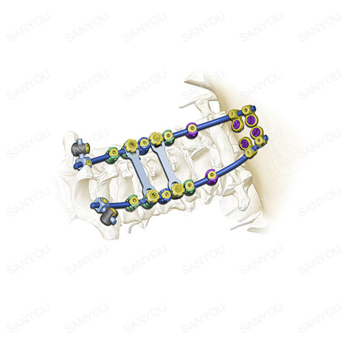 Sistema de osteosíntesis occipitocervical - Cervina® - Shanghai Sanyou Medical - vía posterior / para adulto