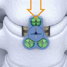 Caja intersomática cervical - Carmen® - Shanghai Sanyou Medical - vía lateral