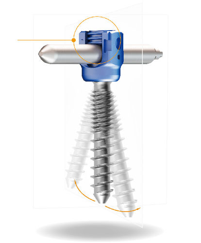 Tornillo pedicular lumbar - Lora™ MIS - Shanghai Sanyou Medical - torácico / canulado / metálico