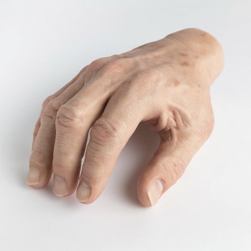 Prótesis estética esterna de mano - schubert and braun prothesenwerk - para adulto