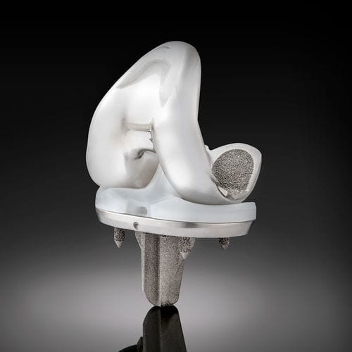 Prótesis de rodilla tricompartimental - Truliant® Porous  - Exactech - de platillo móvil / no cementada