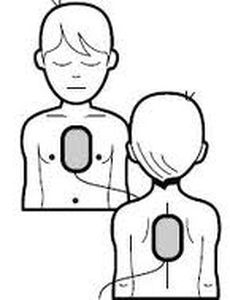 Electrodo de desfibrilación pad - DART Sim ECG Simulator - pediátrica / de monitorización / de pecho