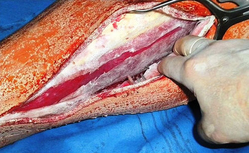 Simulador de formación - Operative Experience Inc. - de fasciotomía / quirúrgico / de pierna
