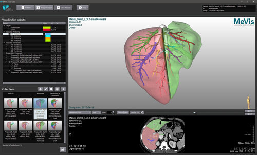 Software de análisis de imágenes - MeVis  - VAREX Imaging - de visualización / de planificación de tratamiento / de importación
