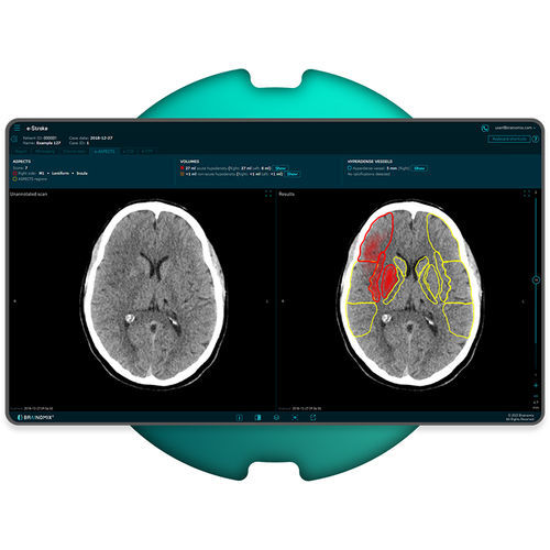 Software para diagnóstico de ictus - e-Stroke - Brainomix - médico / TDM / de análisis de imágenes