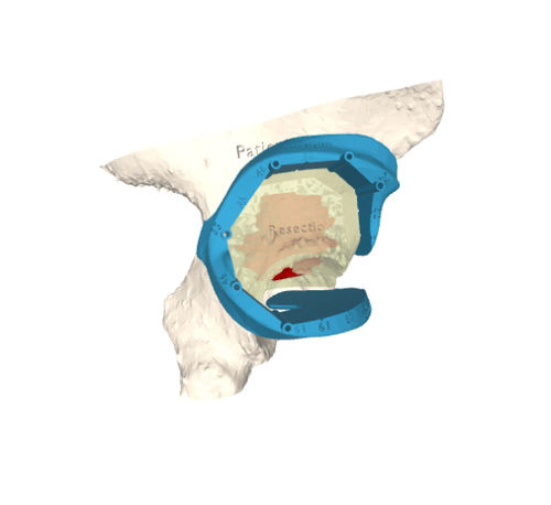 Plantilla de resección para prótesis de cadera - 3D Side