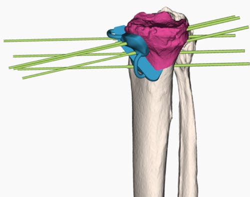 Plantilla de resección para osteotomía tibial - 3D Side