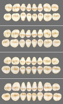 Prótesis dental de fibra acrílica - Classic   - Wiedent - para dientes posteriores