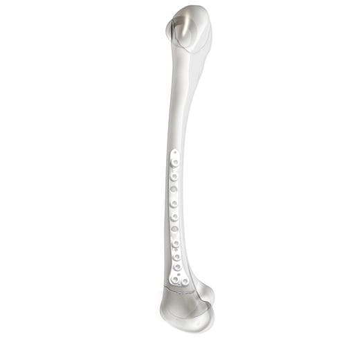 Placa de compresión para fémur - PediLoc® - OrthoPediatrics - porción distal / lateral / bloqueada