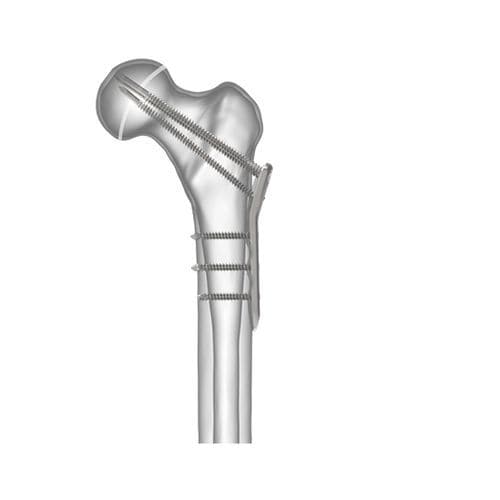 Placa de compresión para cabeza femoral - 00-0903-3840 - OrthoPediatrics - pediátrica