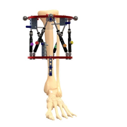 Fijador externo para tibia - ORTHEX - OrthoPediatrics - circular / pediátrico