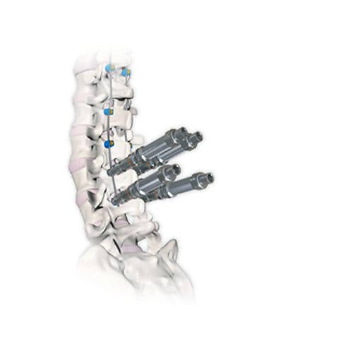 Sistema de osteosíntesis toracolumbar - RESPONSE™ 4.5/5.0 - OrthoPediatrics - vía posterior / pediátrico