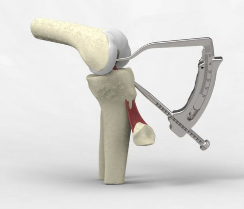 Kit de instrumentos para reconstrucción del ligamento cruzado anterior - NeoSys Medical Solutions