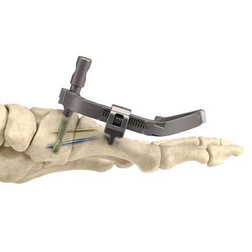 Tornillo de artrodesis para articulación tarsometatarsiana - InCore® - Nextremity Solutions - sin cabeza