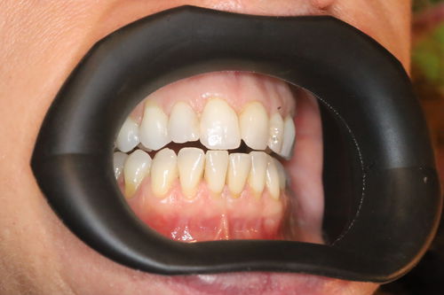 Retractor labial - VisionButler™ - Gate Dental Services Ltd - mejillas / para odontología / apto para autoclave