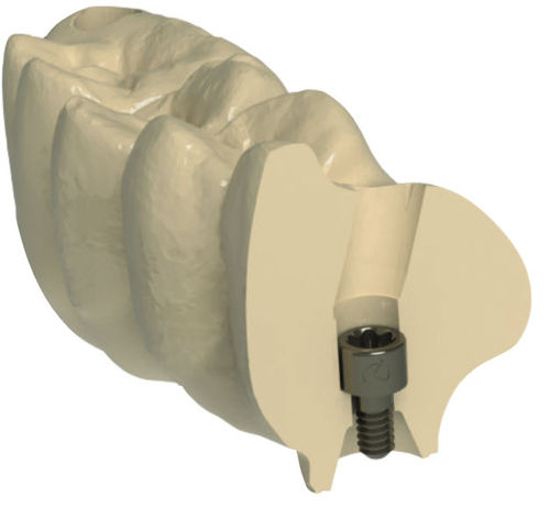 Material de restauración dental - G-DAS - Dynamic Abutment Solutions - CAD CAM / de fresado / altamente translúcido
