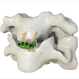 Caja intersomática cervical - 0-P - Irene Ortho - vía anterior / con placa ósea cervical