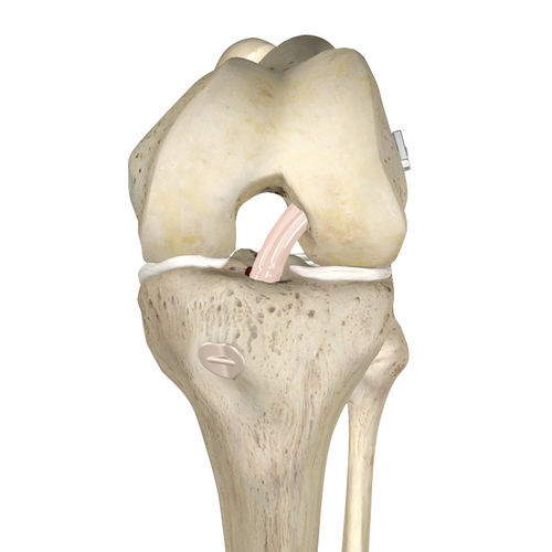 Prótesis de ligamento ligamento cruzado anterior - ANCHORMAN  - VIMS - sintética