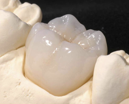Corona dental de circona - CRYSTAL - Derby Dental - de los dientes anteriores / para dientes posteriores