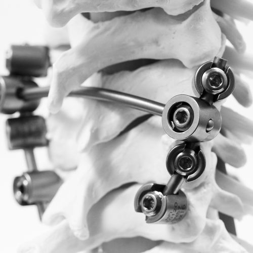 Sistema de osteosíntesis cervical - KM BEBE - NEURO FRANCE Implants - vía posterior / para adulto / pediátrico