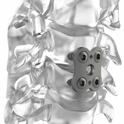 Placa de artrodesis cervical - PM BUTTERFLY® - NEURO FRANCE Implants - bloqueada / de titanio / 2 niveles