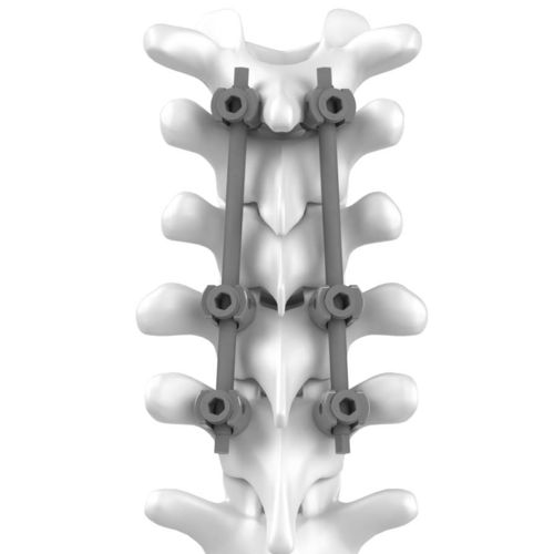 Sistema de osteosíntesis cervicotorácico - C.T.J - NEURO FRANCE Implants - vía posterior / para adulto